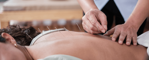 Akupunkturnadeln online kaufen im Kübler Sport Onlineshop Steril verpackte Akupunkturnadeln zur sicheren Anwendung im Therapiebereich