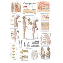 Lehrtafel - Osteoporose