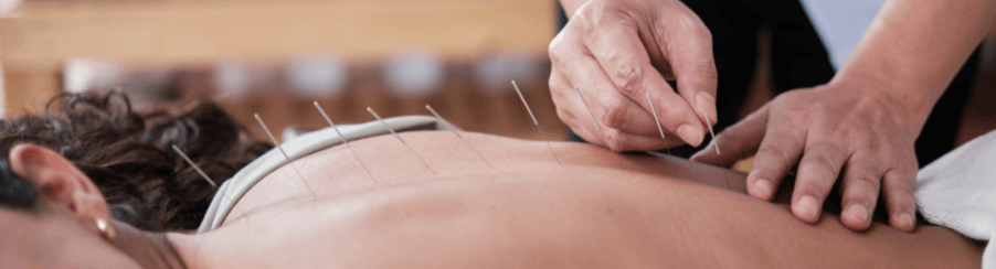 Steril verpackte Akupunkturnadeln zur sicheren Anwendung im Therapiebereich